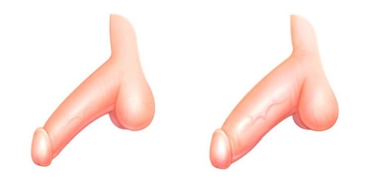 Miembro antes y después de aumentar